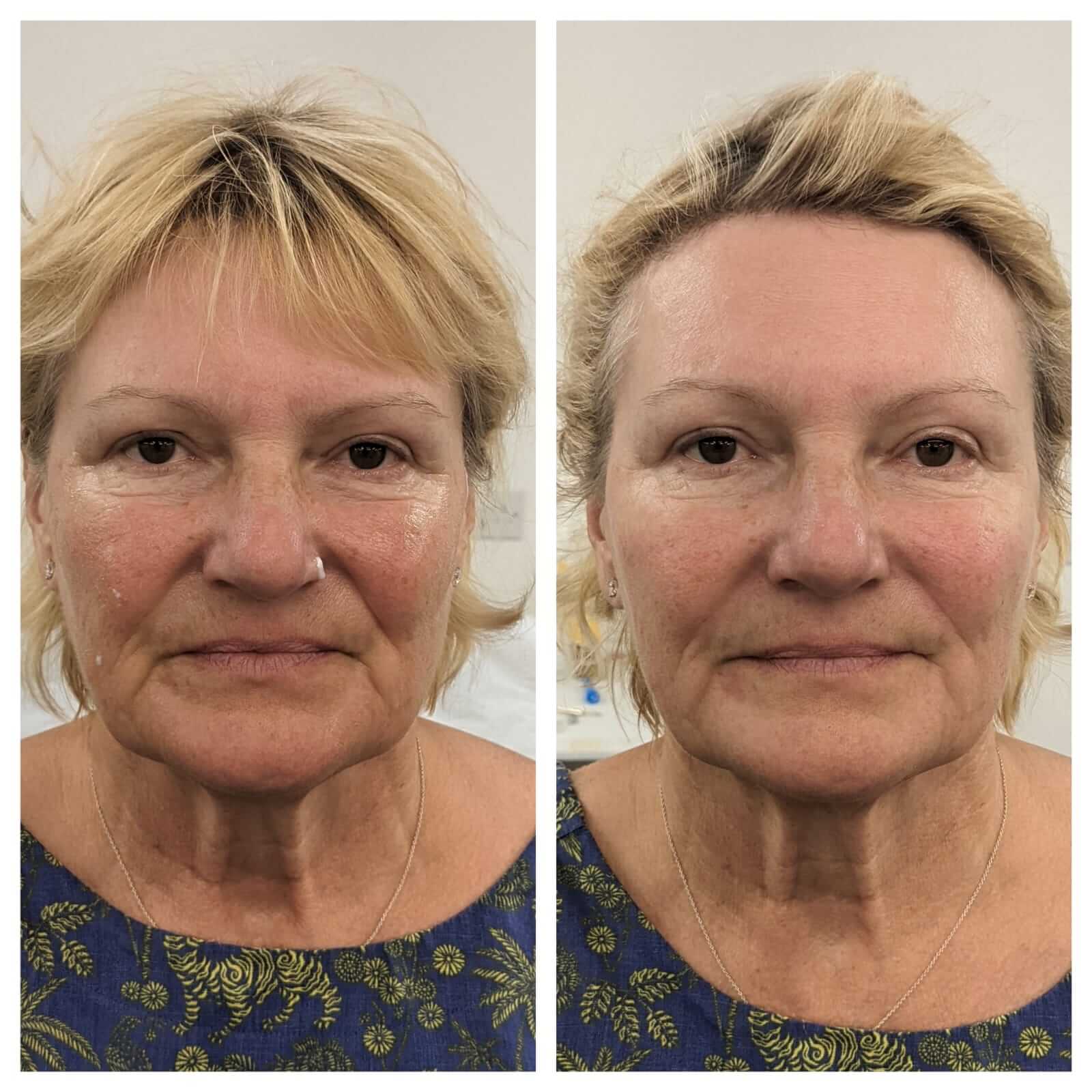cheek-augmentation-before-and-after