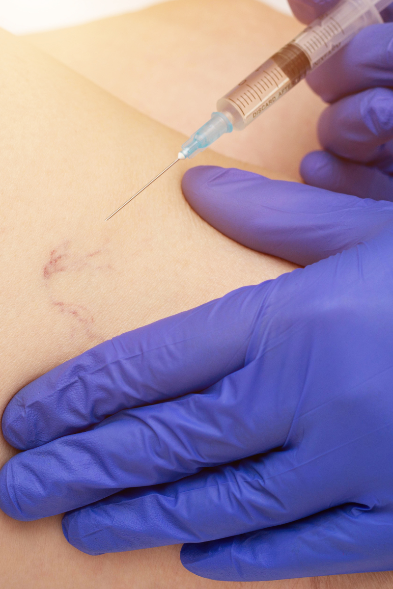 sclerotherapy-kent